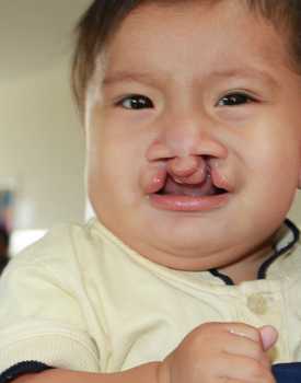 Wilber before surgery